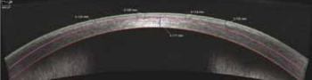 Cirrus HD - OCT 5000 - Scan de cornea